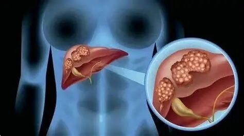 肝癌治疗不再“一刀切”！带瘤生存也能高质量生活