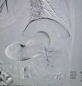 微创保脾，精准施治！我院介入科成功开展脾动脉栓塞术，化解肝硬化脾亢难题