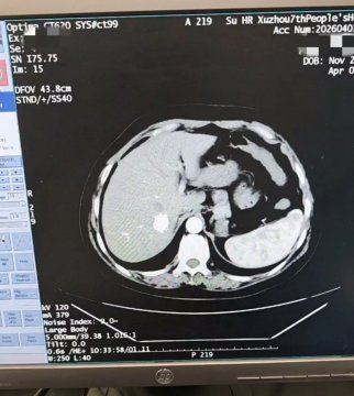 京徐协作 精准祛瘤 ║我院成功开展复杂肝癌微波消融术